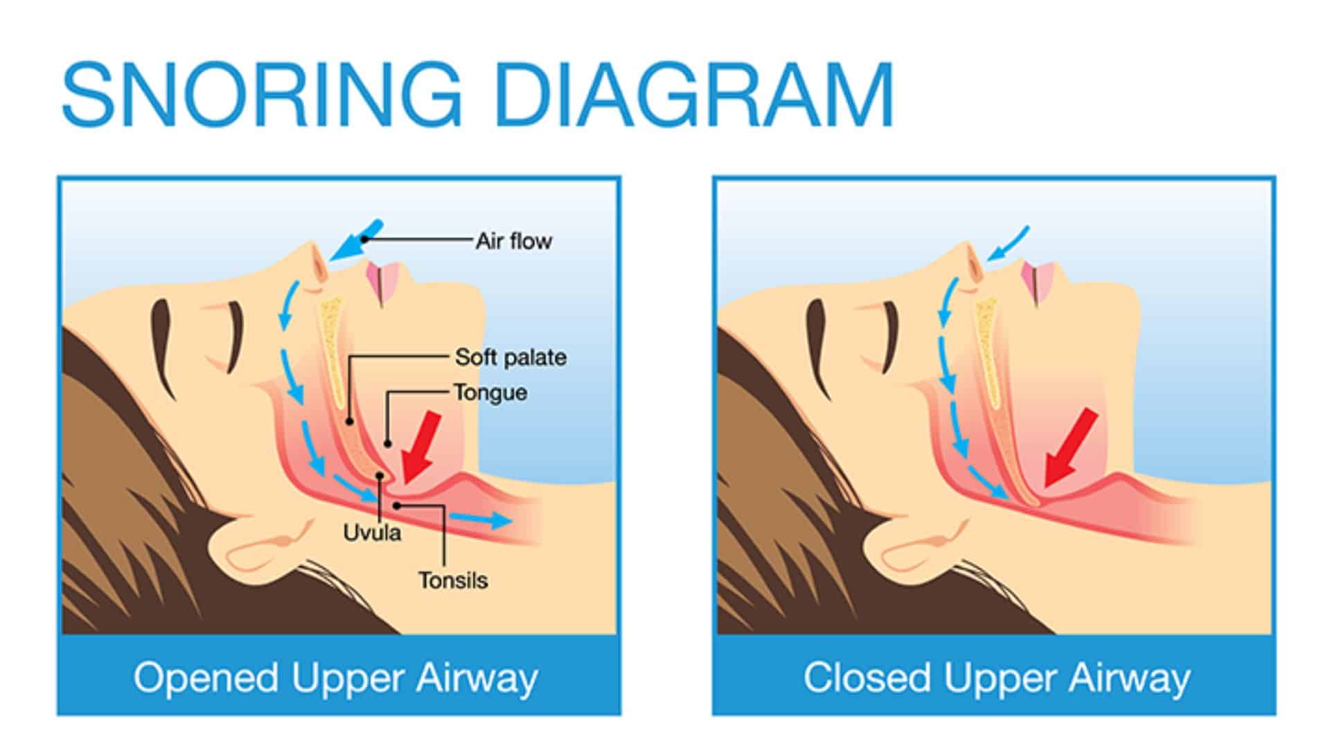 Pictorial showing internal cause of snoring
